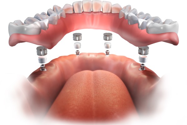 All On   Is A Minimally Invasive Solution For Missing Teeth